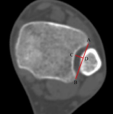 A Quantitative Method for Intraoperative Evaluation of Distal Fibular Malrotation